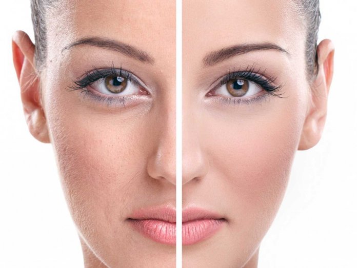 5 passos importantes para reduzir os poros dilatados